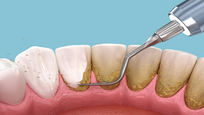 بهترین ایمپلنت اصفهان | بهترین دندانپزشک زیبایی اصفهان | بهترین دندانپزشک اصفهان | بهترین دندانپزشک کودکان اصفهان | مراحل تخصصی جرمگیری دندان در کلینیک دندانپزشکی دکتر مکانیک