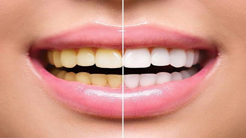 جرم‌گیری و اصلاح طرح لبخند در اصفهان